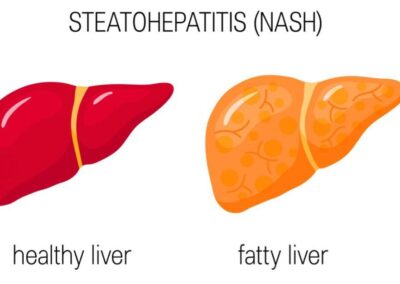 Steatoepatite non alcolica (NASH)